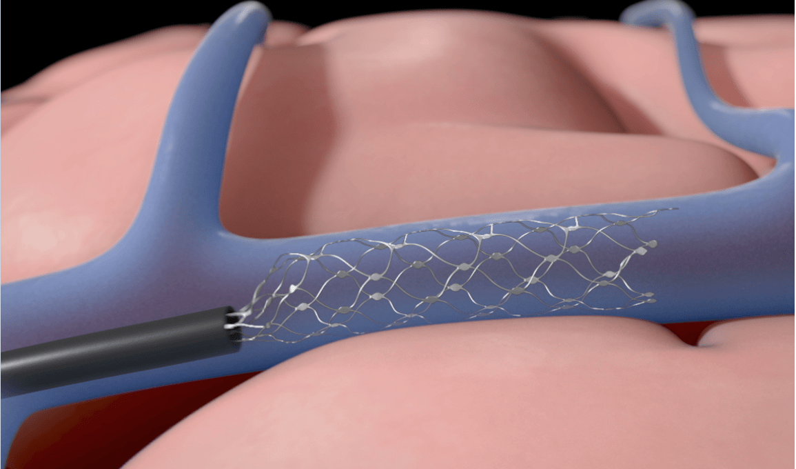 synchron series khosla venturesparkfiercebiotech