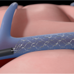 synchron series khosla venturesparkfiercebiotech