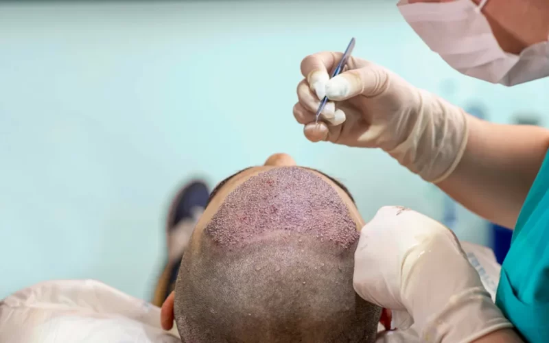 Understanding The Unique Hair Characteristics of African-American Hair For Hair Transplantation