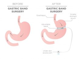 5 Surprising Benefits of Adjustable Gastric Balloon For Weight Loss