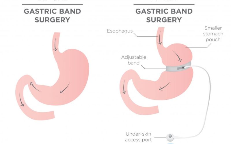 5 Surprising Benefits of Adjustable Gastric Balloon For Weight Loss