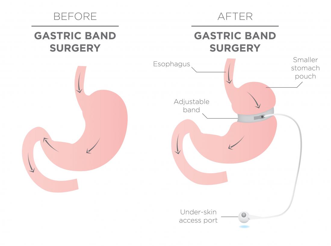 5 Surprising Benefits of Adjustable Gastric Balloon For Weight Loss